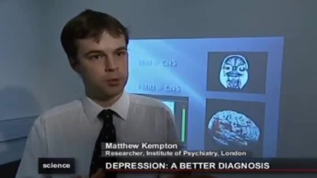 ⁣کوچک شدن مغز انسان به علت افسردگی